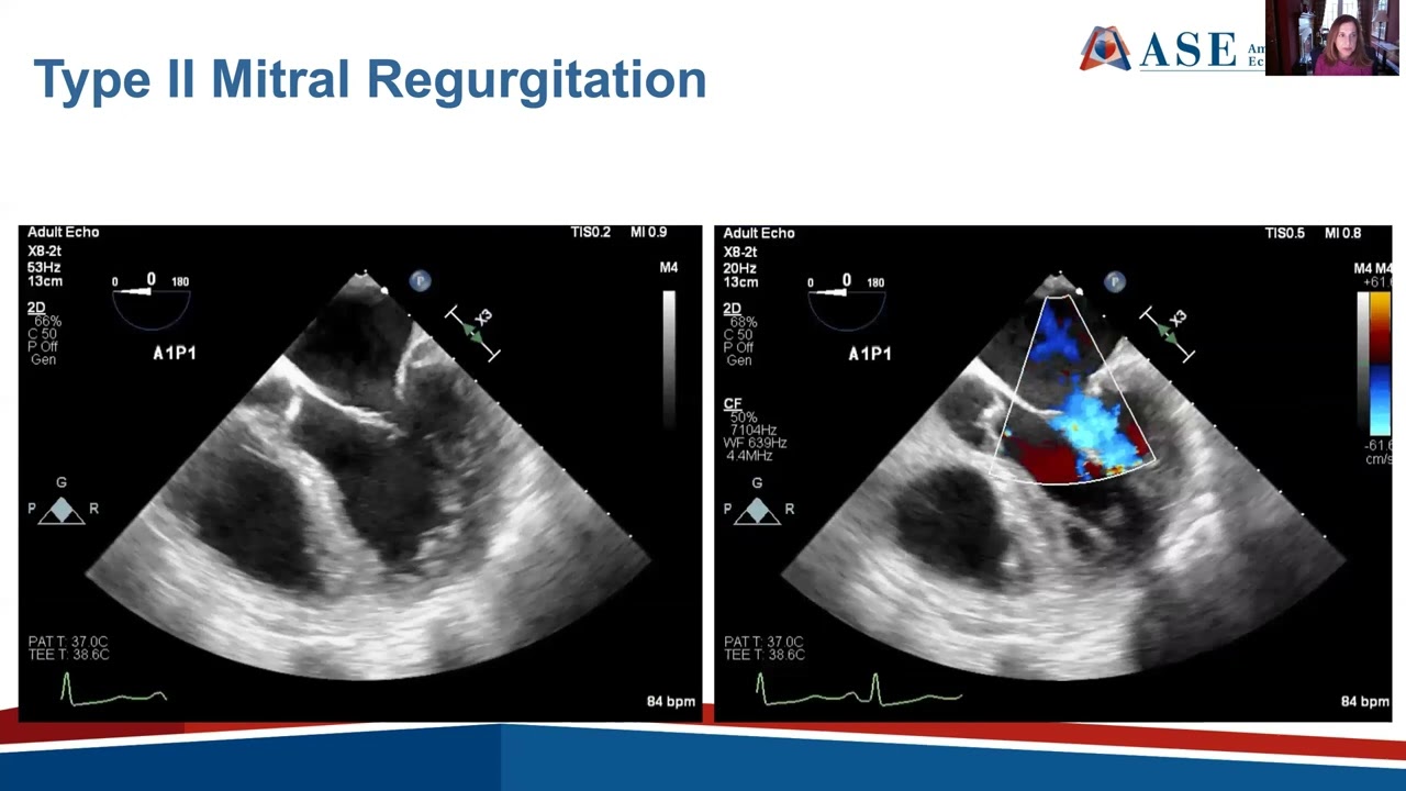 ASE 2021 Functional Secondary Mitral Valve Disease
