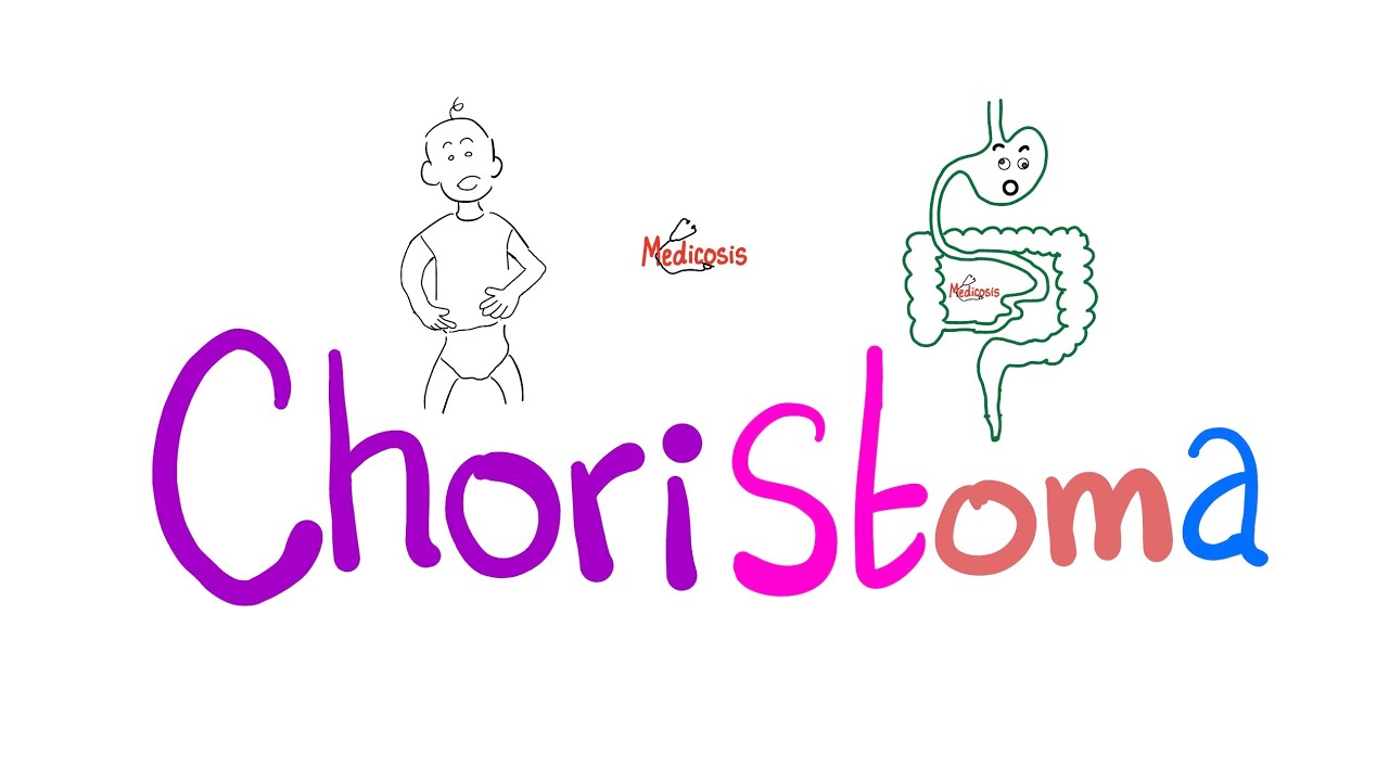 Choristoma (Not a Hamartoma, and Not a True Neoplasia) | Pathology Series
