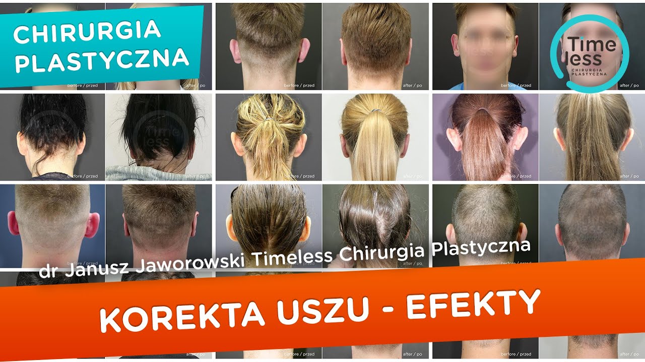 #Korekcjauszu, #otoplastyka - efekty po zabiegach korekty uszu