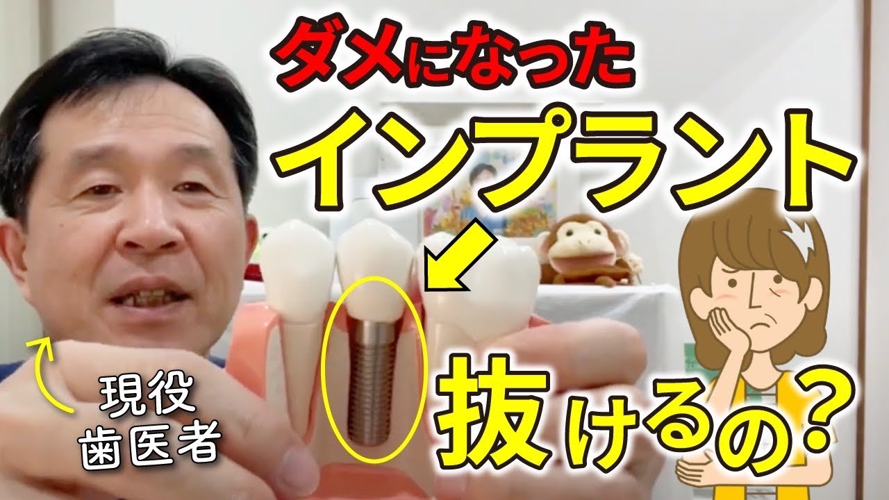 ダメになったインプラントは抜くことができるの？歯医者がわかりやすく解説‼︎