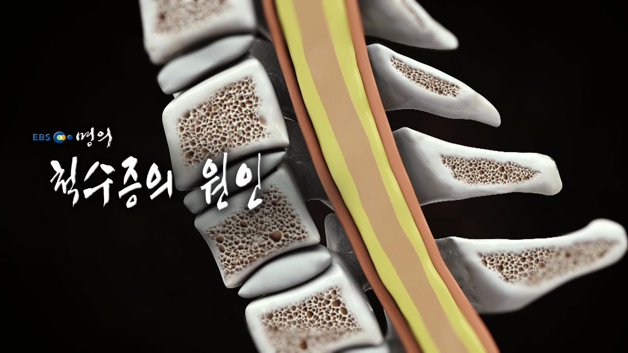 [명의 의학백과📖] 척수증의 원인