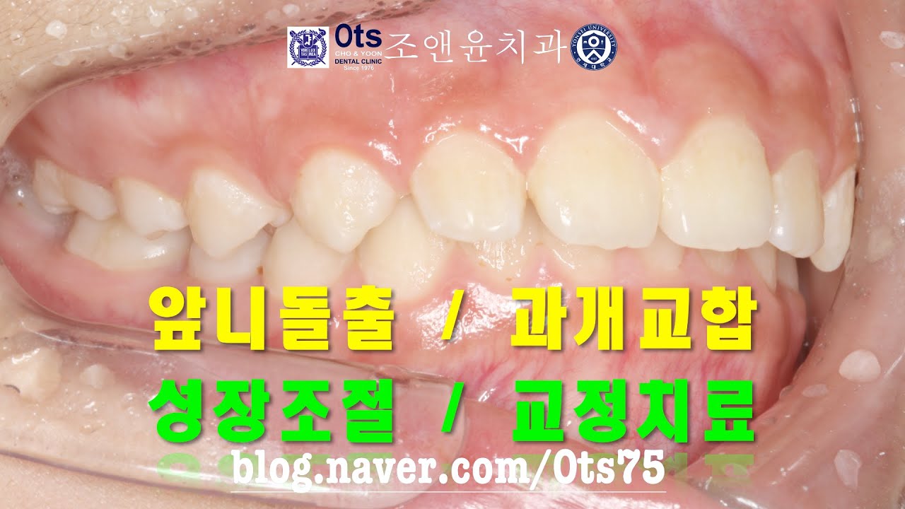 [완벽주의 치과의사 Perfectism] 앞니 과개교합, 성장조절과 교정치료 : Anterior deep bite, Bionator & bracing