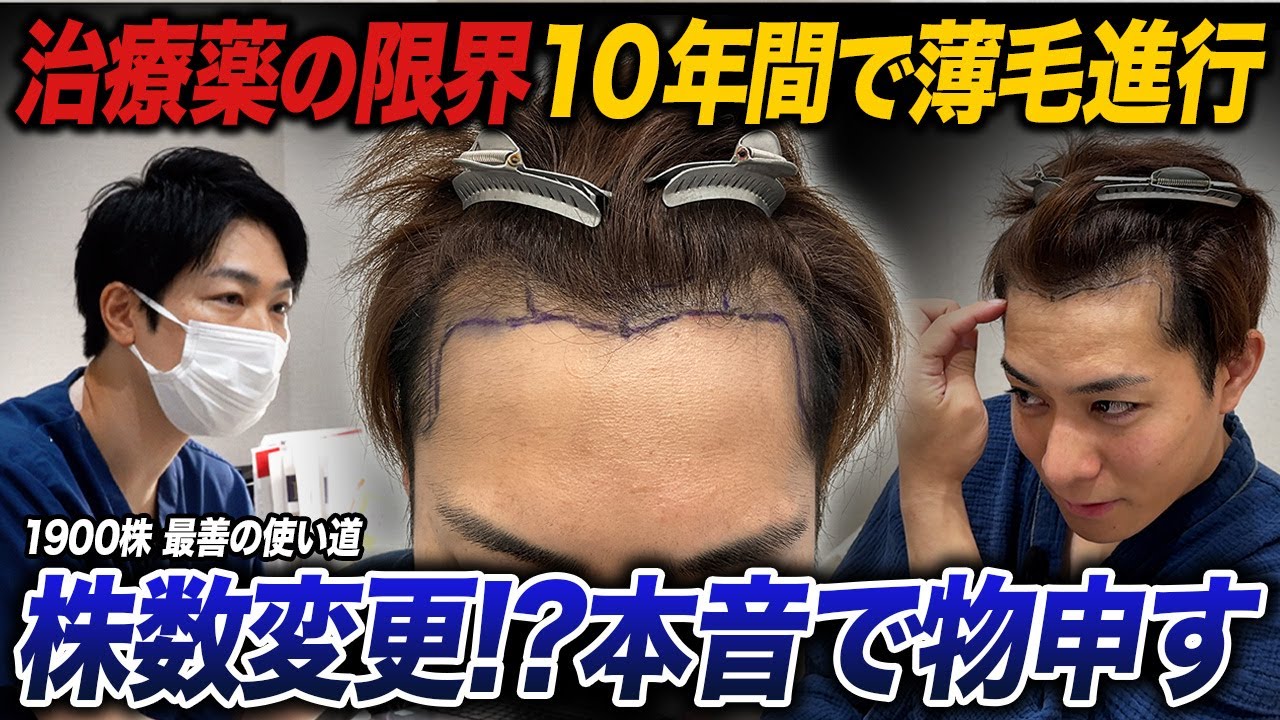 「やっと薄毛を治せる」長年の治療の末｜30代男性1900株の最善の使い道