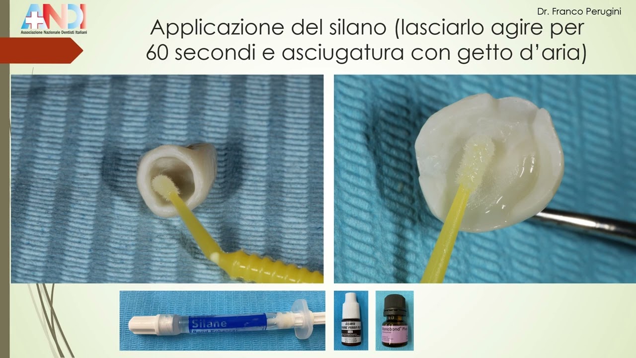 Cementazione adesiva. Parte 1: substrato protesico