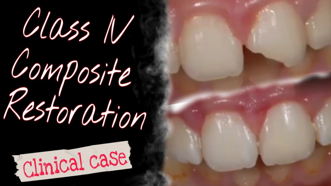 Class IV Composite Restoration Clinical case