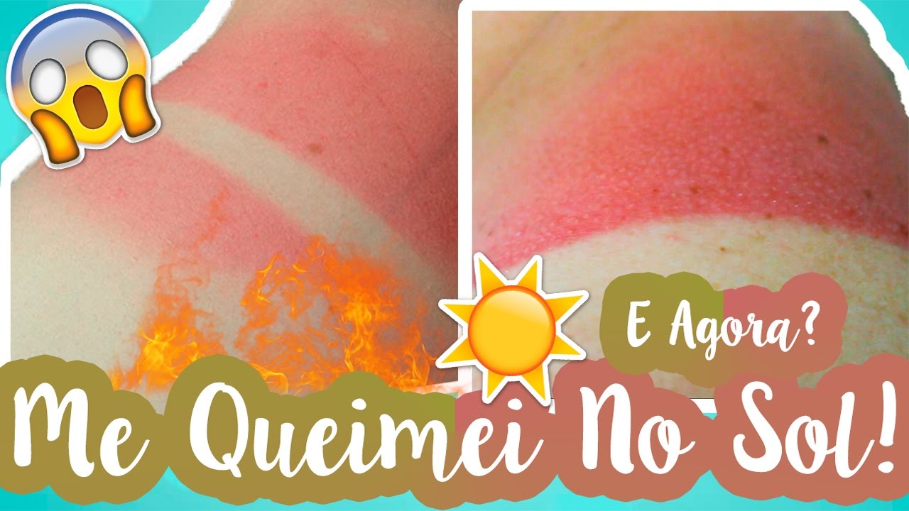7 Dicas Para Prevenir e Tratar Queimaduras de Sol E Insolação! #VEDA8 ❥ Lói Cúrcio