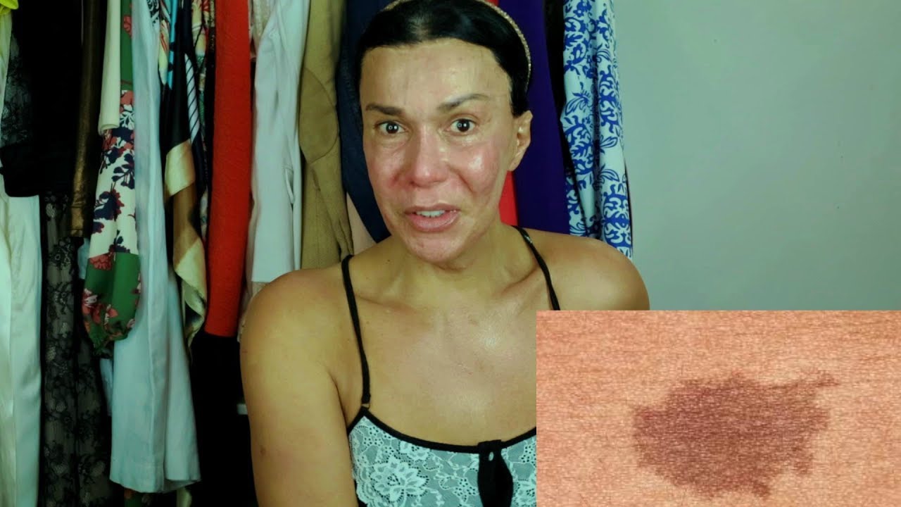 ELIMINE DE VEZ AS MANCHAS DO SEU ROSTO | JOANNA MARIA, A CAPIXABA NA ISLÂNDIA