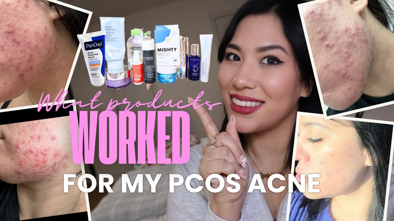 how I cleared my pcos hormonal acne with my top drugstore products | my personal pcos tips
