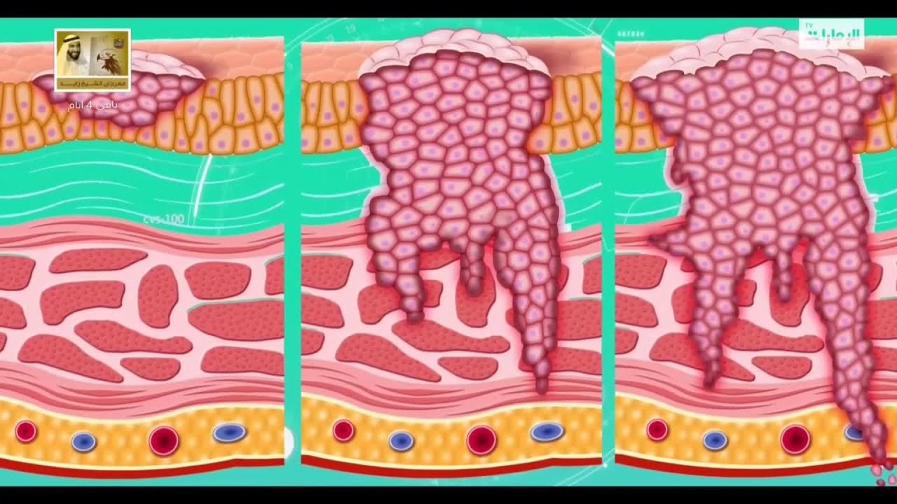 صحة وحياة | أعراض سرطان المثانة ومسبباته