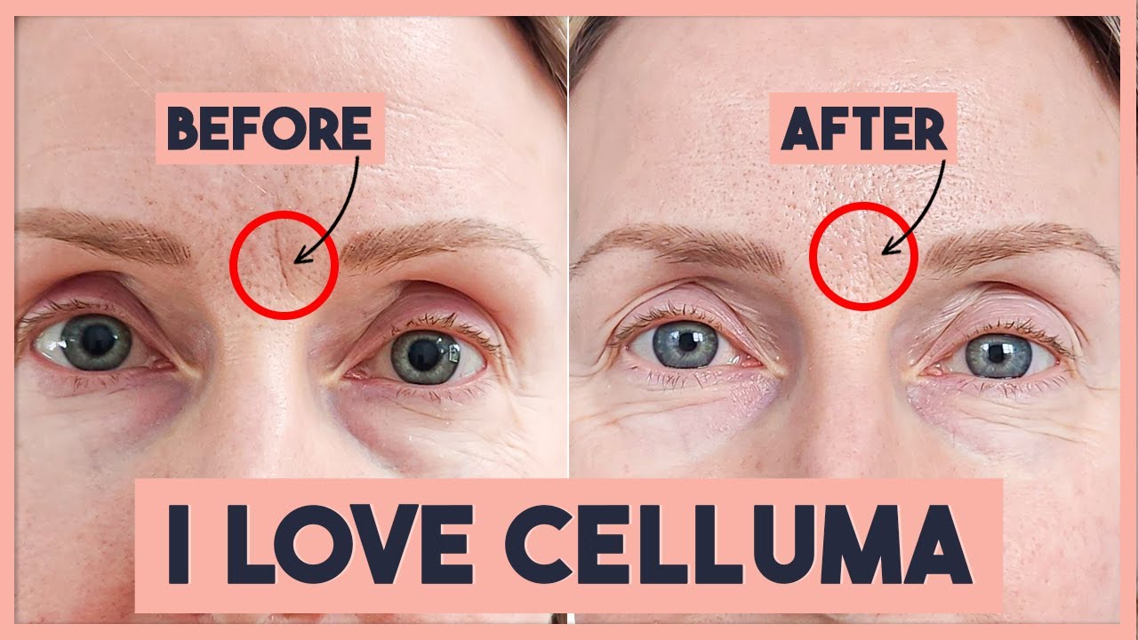 The Celluma Pad | Amazing Progress In Just 2 MONTHS! Red Light Therapy