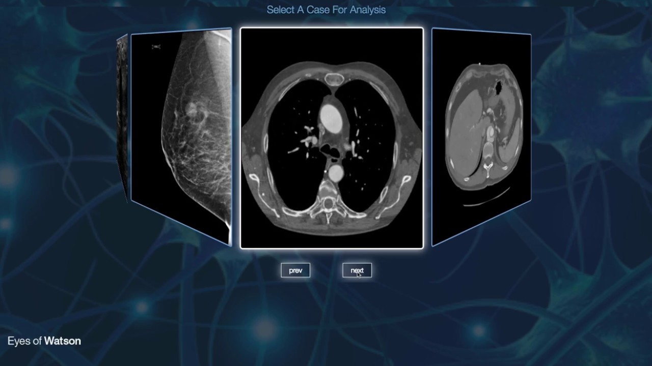 IBM researchers bring AI to radiology
