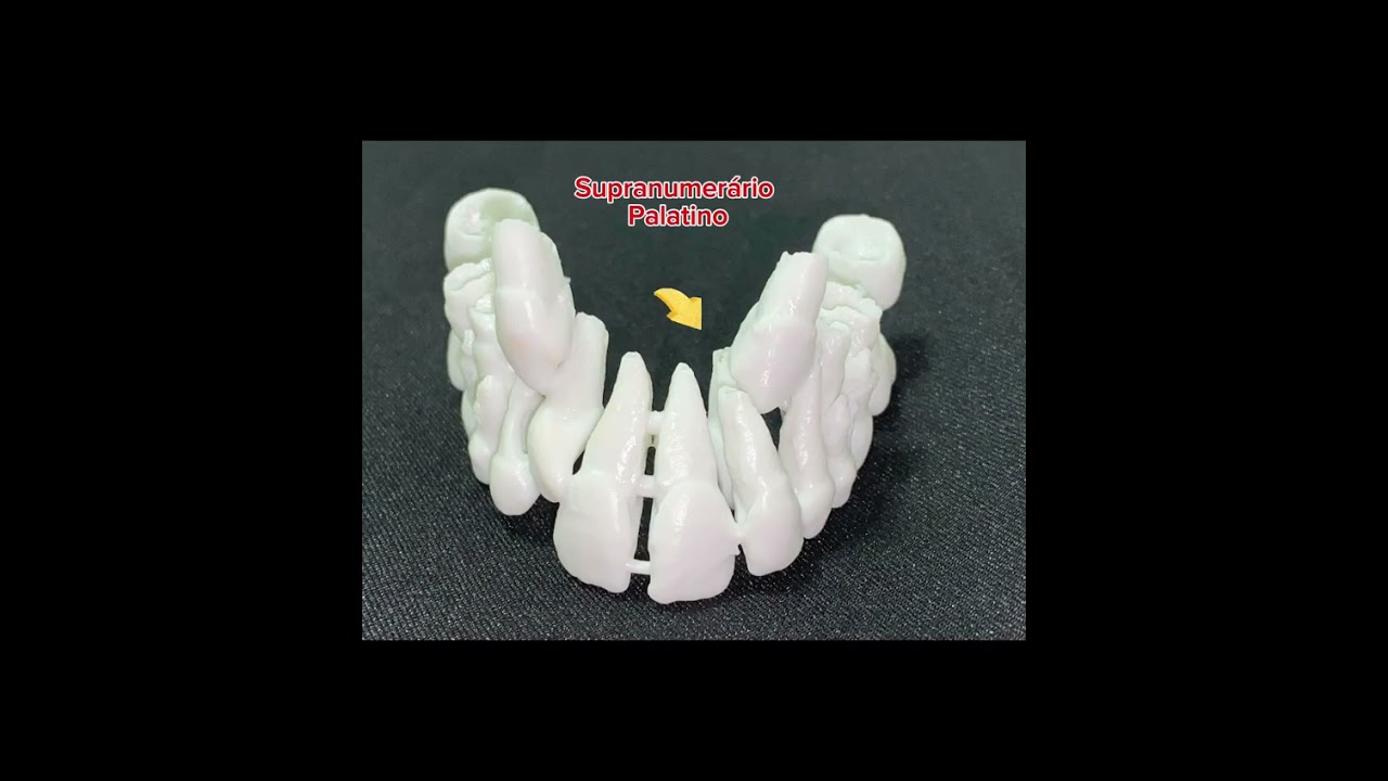 Supernumerary teeth