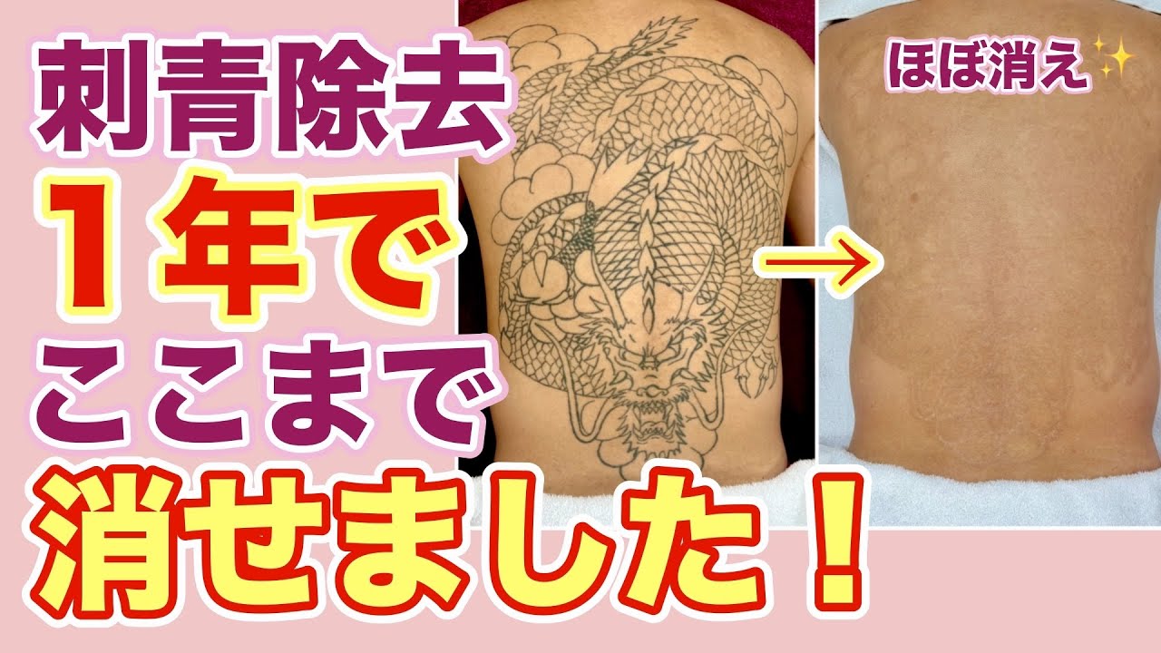【ピコレーザー】年パス1年でここまで消せました！レーザーによるタトゥー除去922【ピコウェイ＆エンライトン】