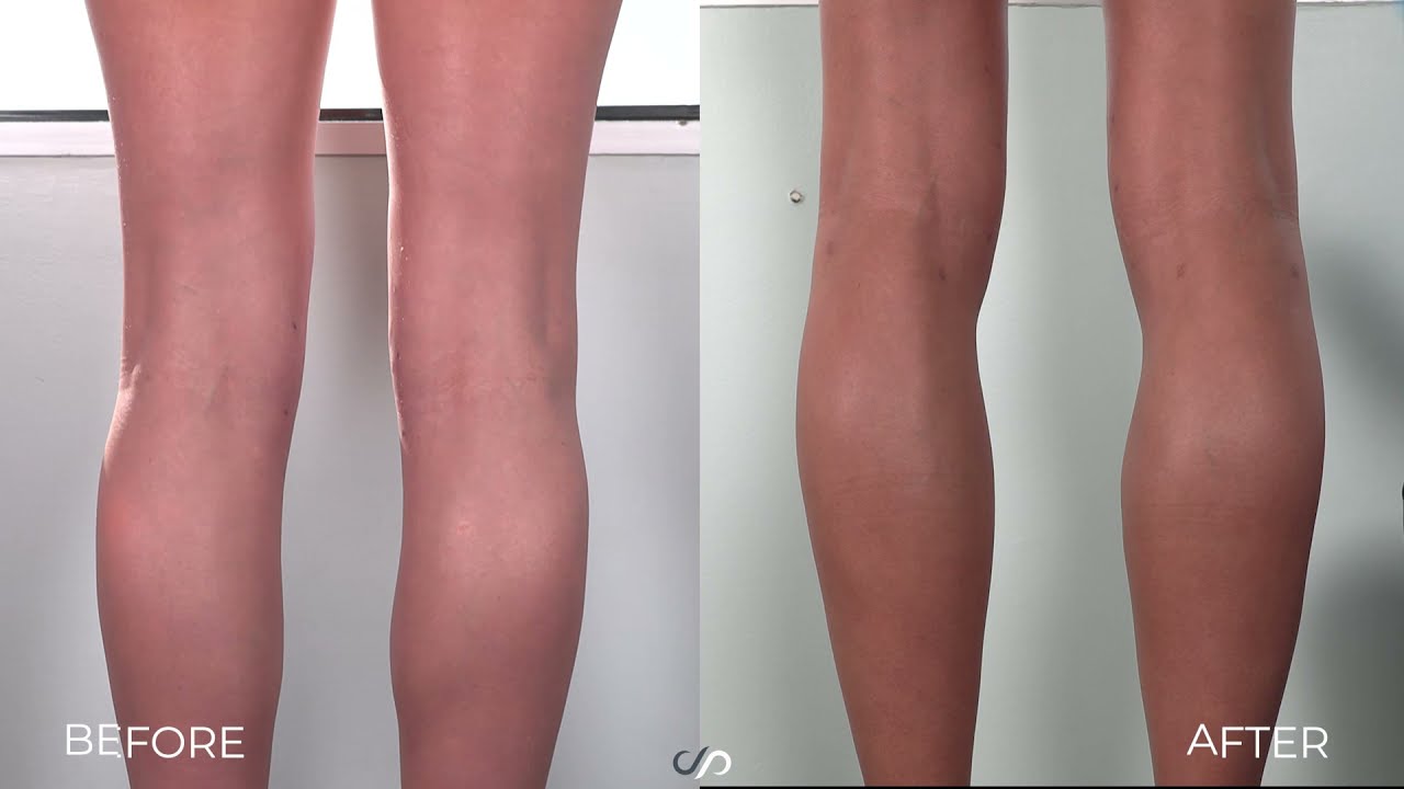 How to Get Rid of Cankles Using Liposuction | Los Angeles