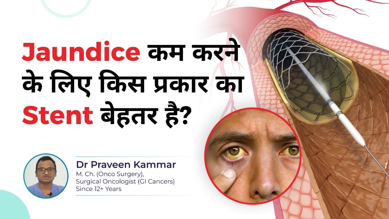 Best Stent for Bile Duct Cancer-Related Jaundice | Metal or Plastic Stent? | Dr Praveen Kammar