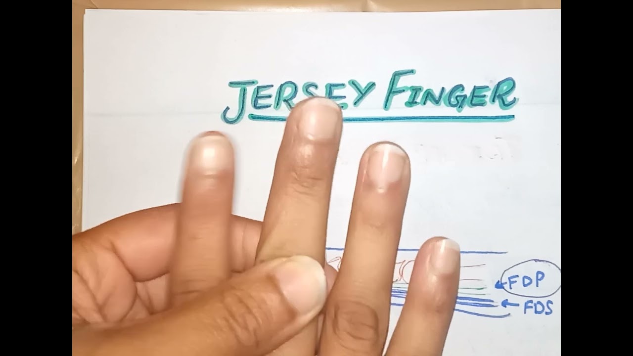 Jersey Finger #sportsinjuries