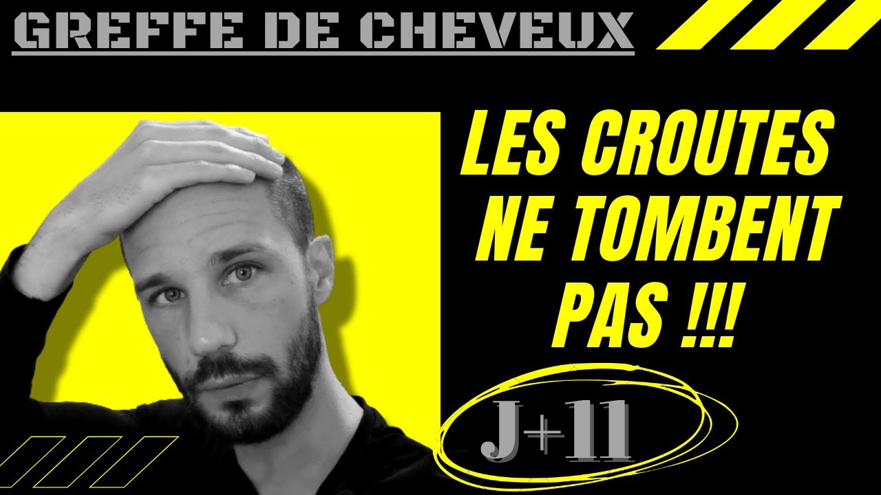 GREFFE de CHEVEUX DHI J+11 Fini les CROUTES, comment les retirer ?