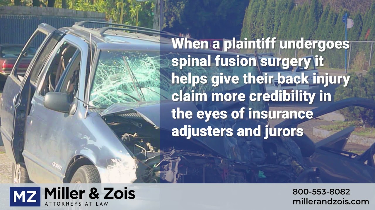 Spinal Fusion Surgery Settlement Value in Accident Cases