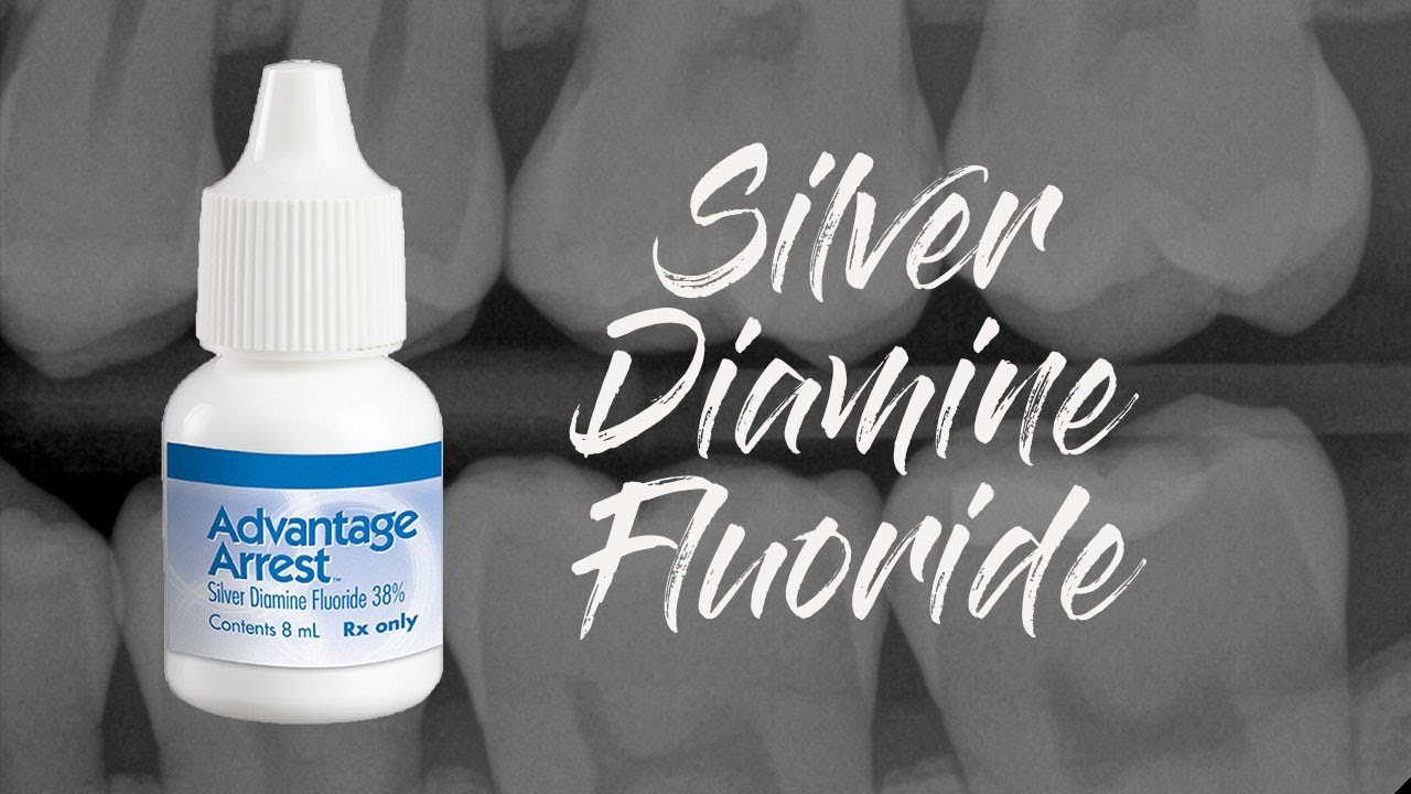 SILVER DIAMINE FLUORIDE for Incipient Caries & CHANNEL UPDATES