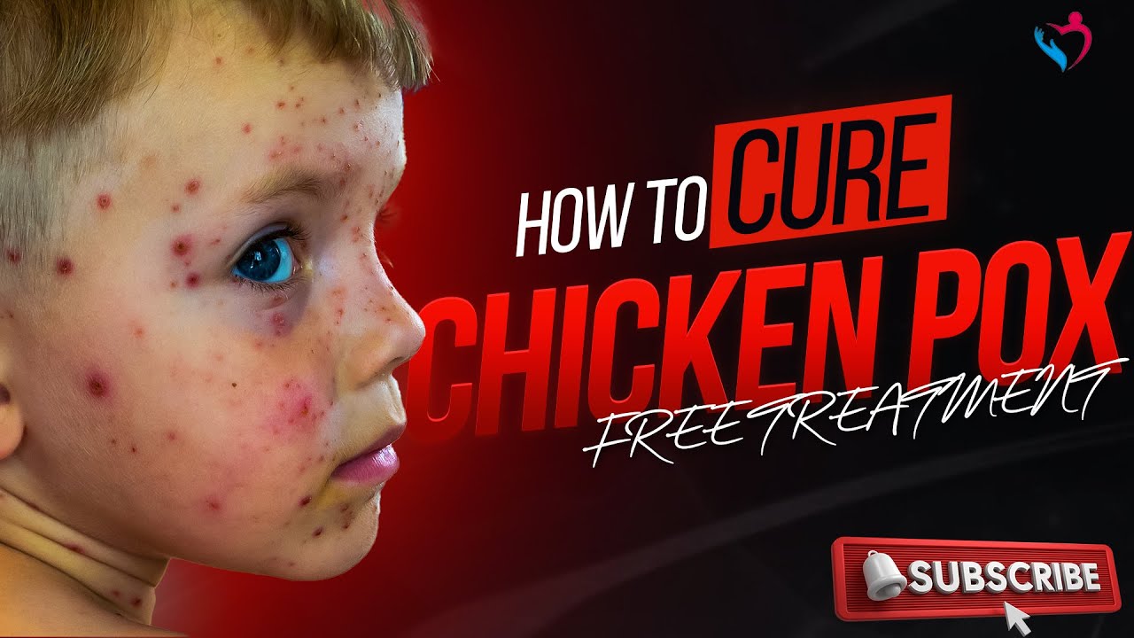 Chickenpox Marks & Scars Treatment | Face Clear Karne Ka Nuskha | Dr Ibrahim | Chickenpox Nishan
