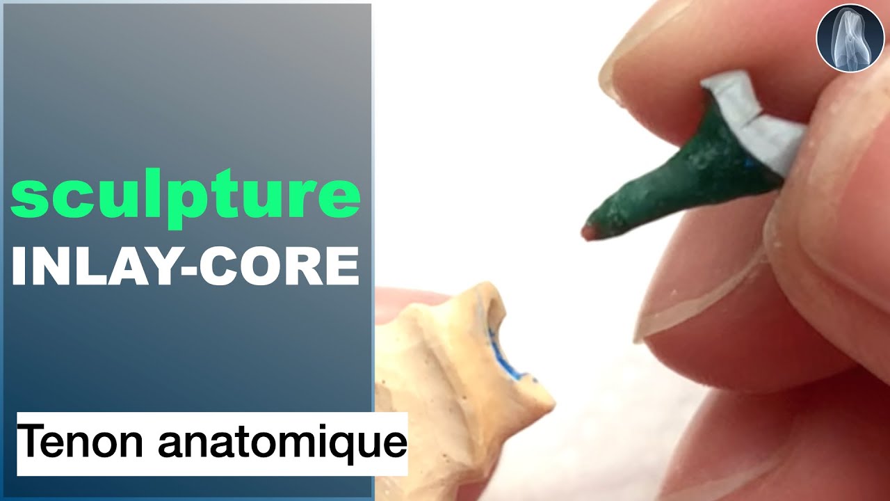 Comment Concevoir un Inlay-Core à Tenon Anatomique Pas à Pas 🦷💡