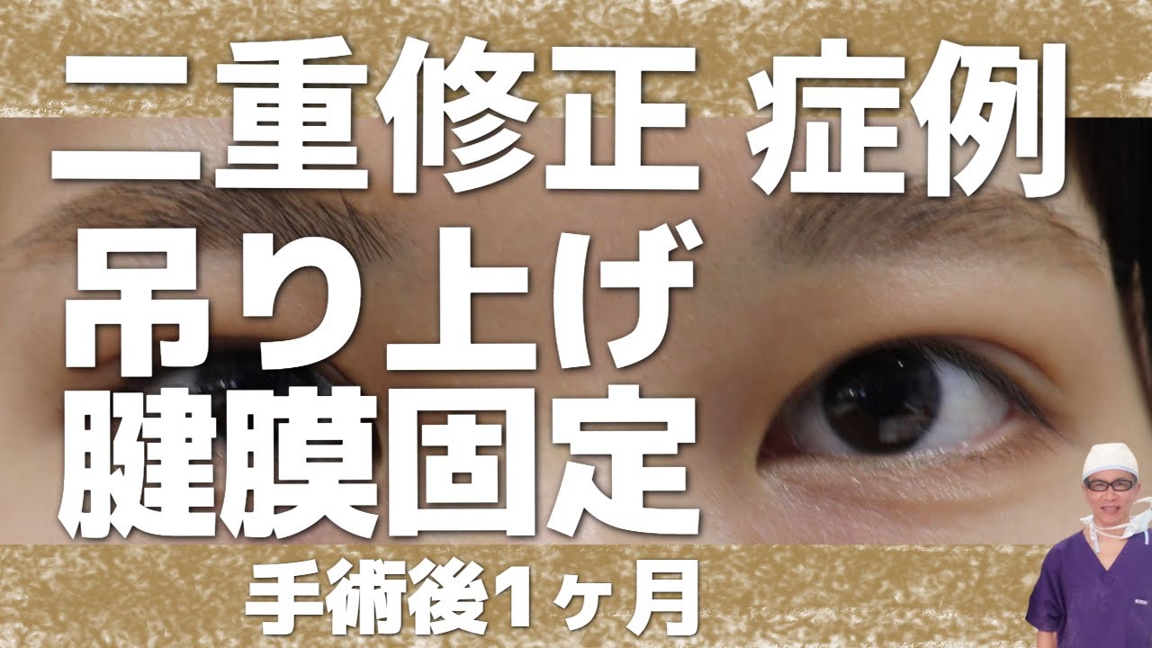 二重修正・吊り上げ・腱膜固定をした症例。手術後1か月後。腫れ具合を参考に