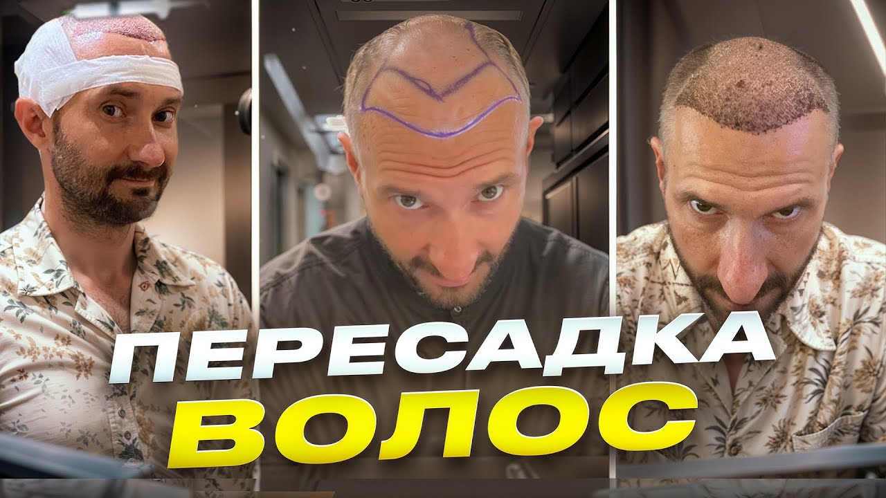 Пересадка волос и инвестиции / Боль, гарантии, что самое тяжелое