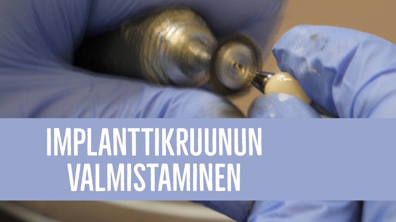 Implanttikruunu ja hammasimplantti - hammasteknikko valmistaa - hammaslääkäri kertoo - tiede
