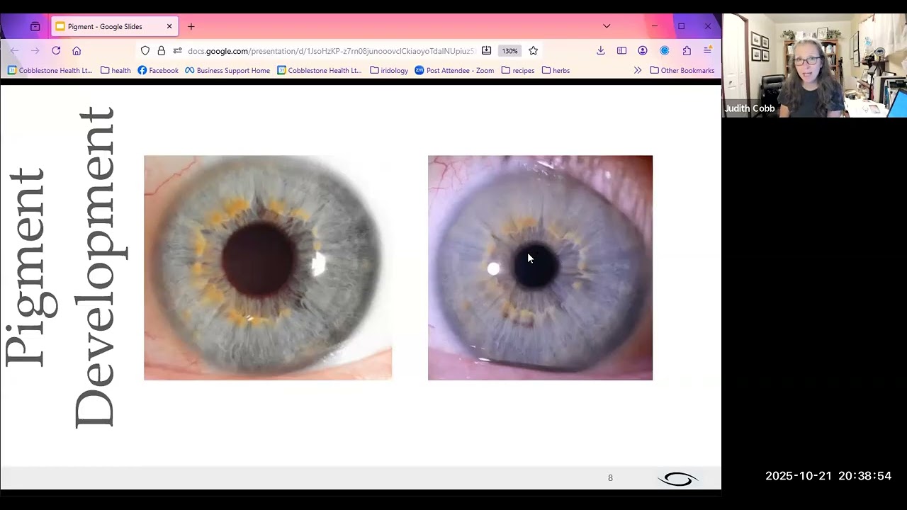Pigments (Freckles) in Eyes
