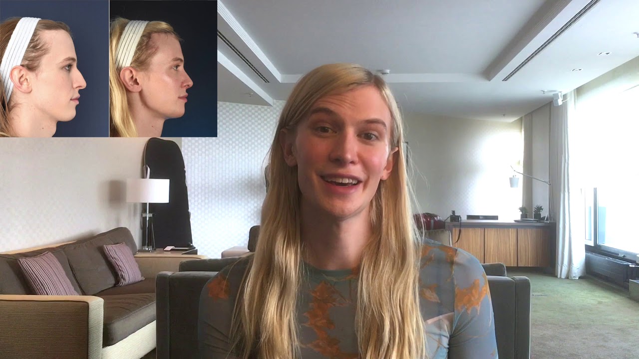 Facial Feminization Surgery Review - Lyra, Dr Bart van de Ven reviews