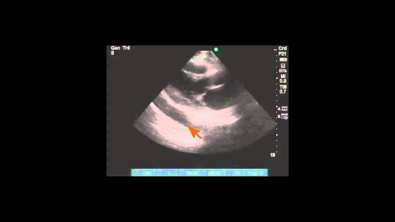 Differentiating pleural vs pericardial effusion by anatomy on echo