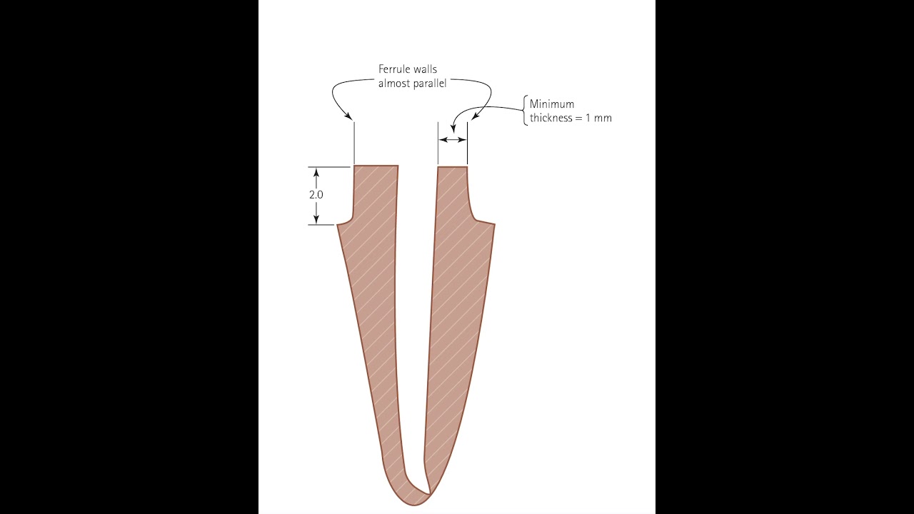 Ferrule effect. Dr. Mazen Doumani