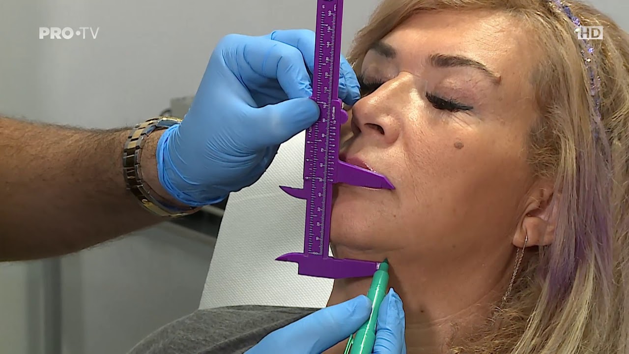 Tratament barbie dubla - Dr. Morad Iancu, Luxury Aesthetics