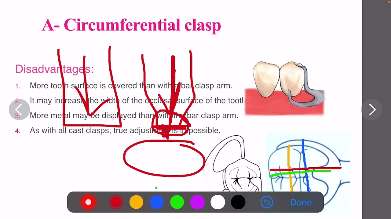 3-11 Prosthodontics, Types of clasp assemblies (1).