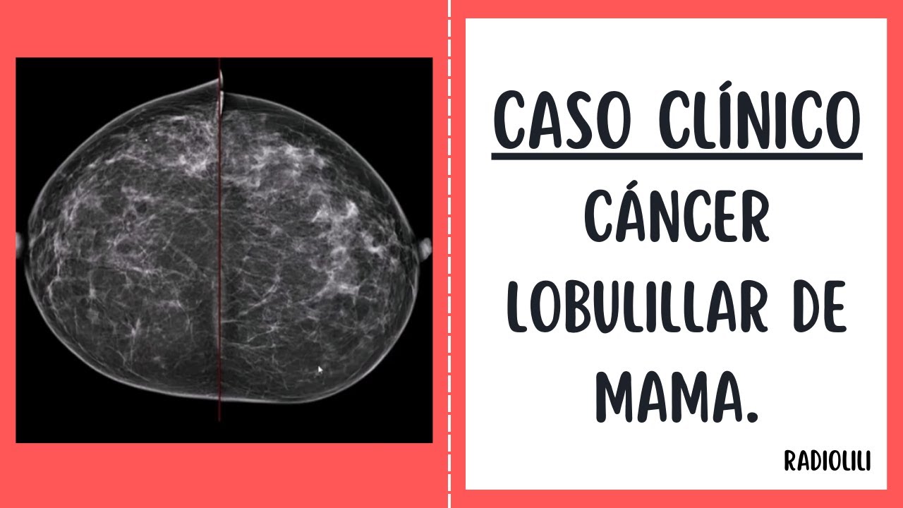 Caso Clínico 93: Cáncer lobulillar de mama.