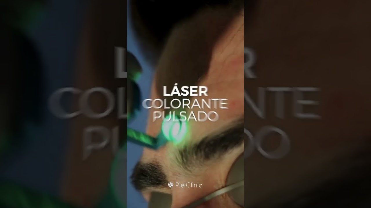 Láser Colorante Pulsado ✨  