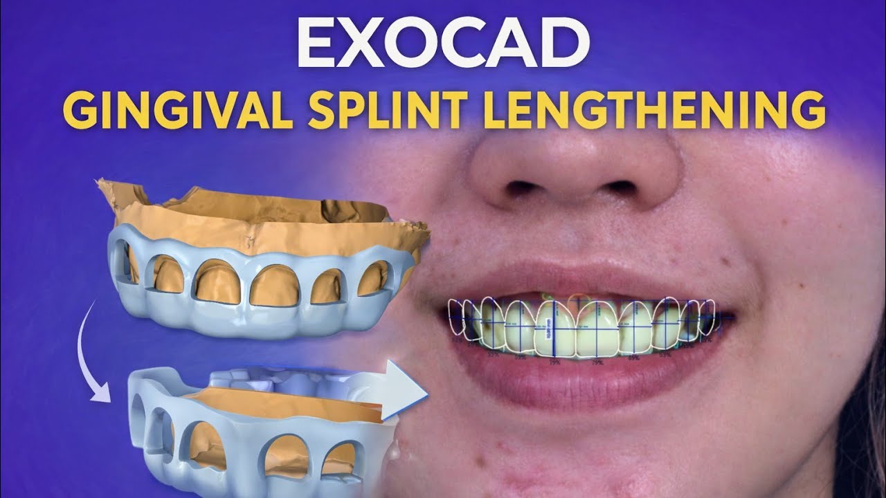 Exocad Gingival Splint Lengthening | Advanced Gingiva Design Tutorial by Ratanician