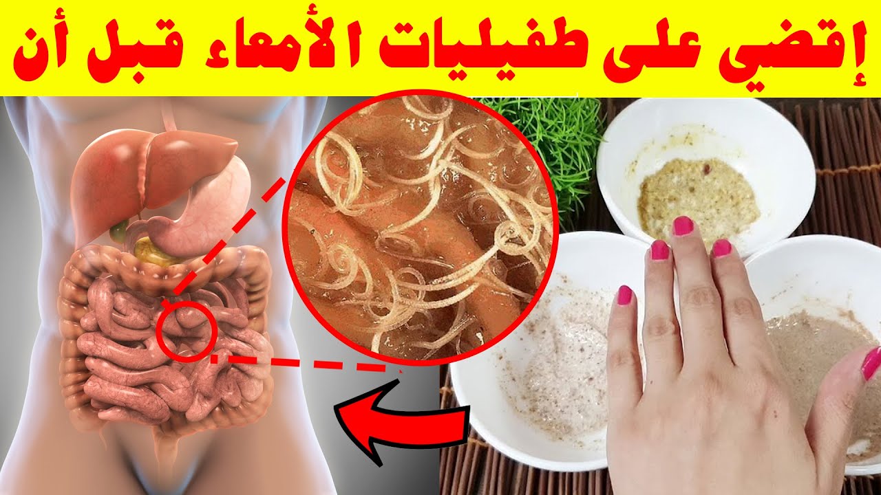 خطير!! أسرع علاج طبيعي للطفيليات المعوية من اول استعمال! تخلص من الديدان المعوية بطريقة منزلية بسيطة