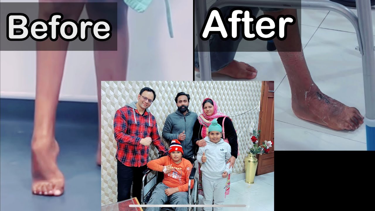 “From Impossible to Possible: Recovery of Foot Deformity after Surgery” |Dr A.F.Khan