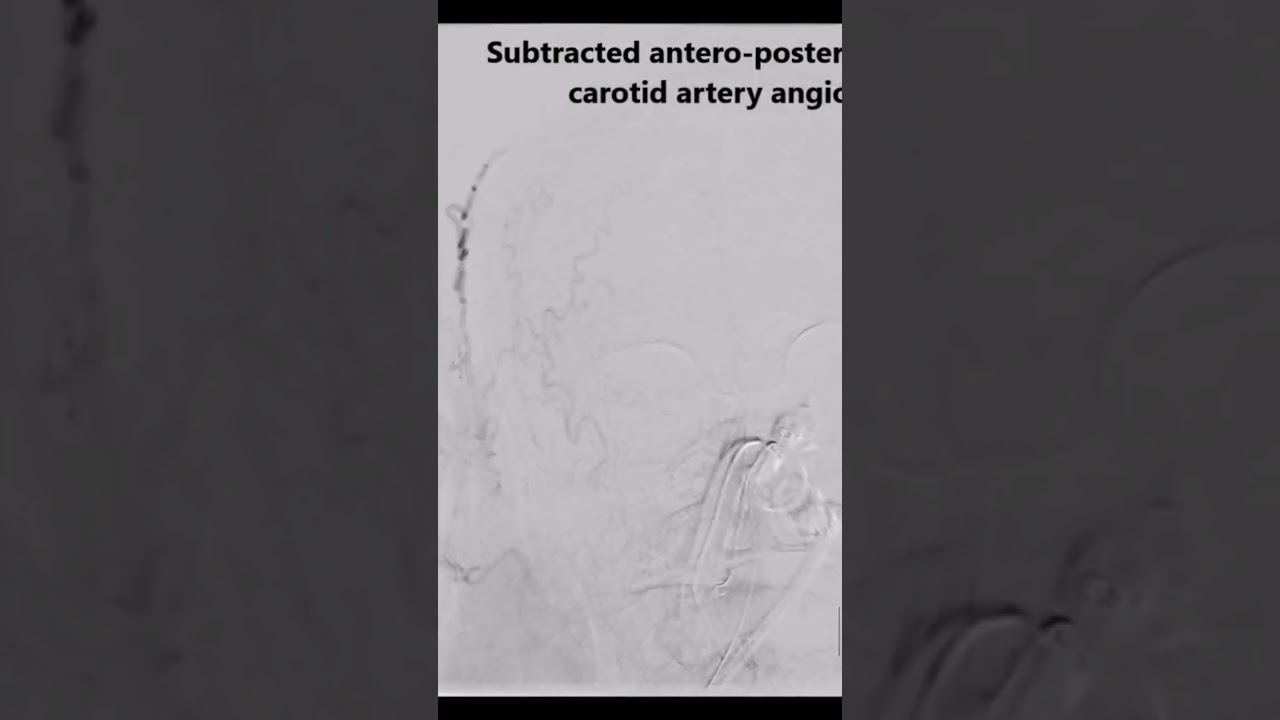 External Carotid Artery Angiogram #shorts