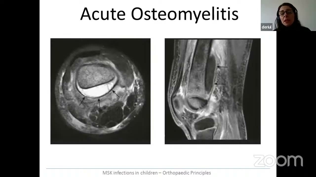 MSK Infections in Children- ICL