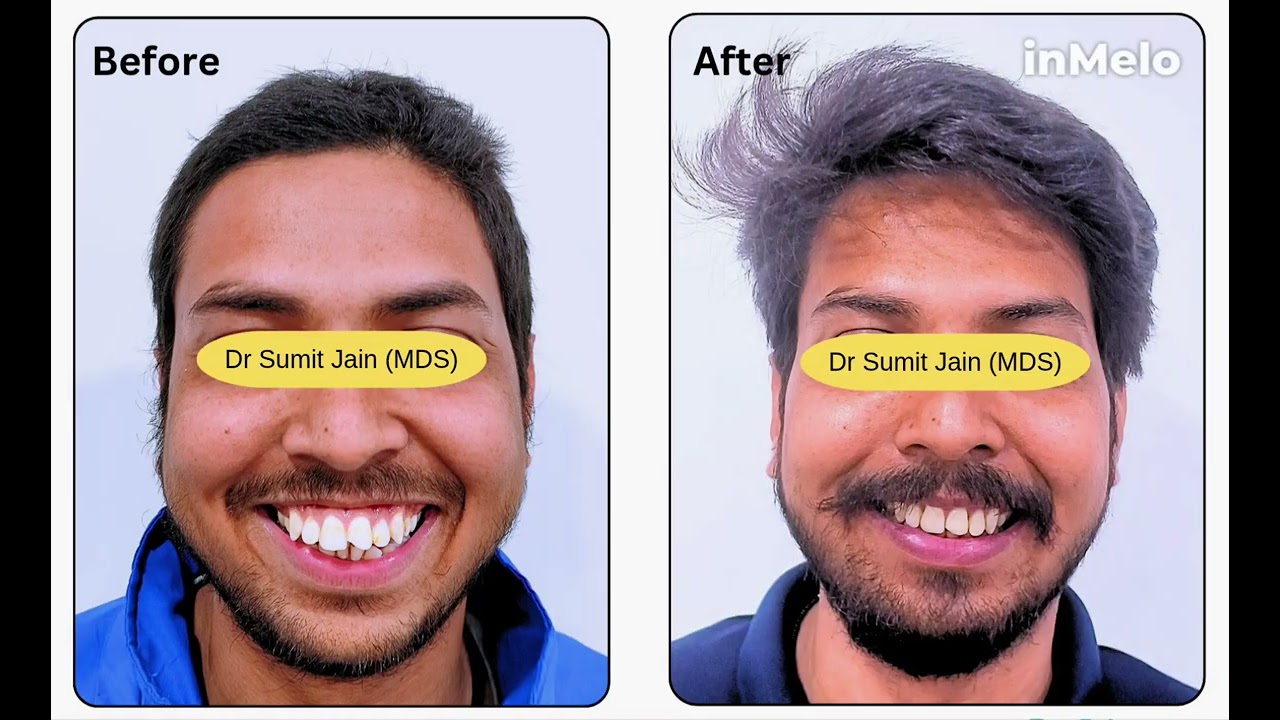 Fix Forwardly Placed Teeth | Braces & Invisalign by Dr. Sumit Jain (Jabalpur)