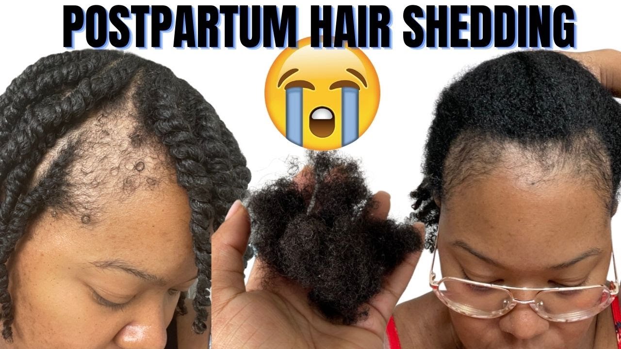 My Postpartum Shedding & Hair Loss: 5 Tips on How To Manage Postpartum Shedding