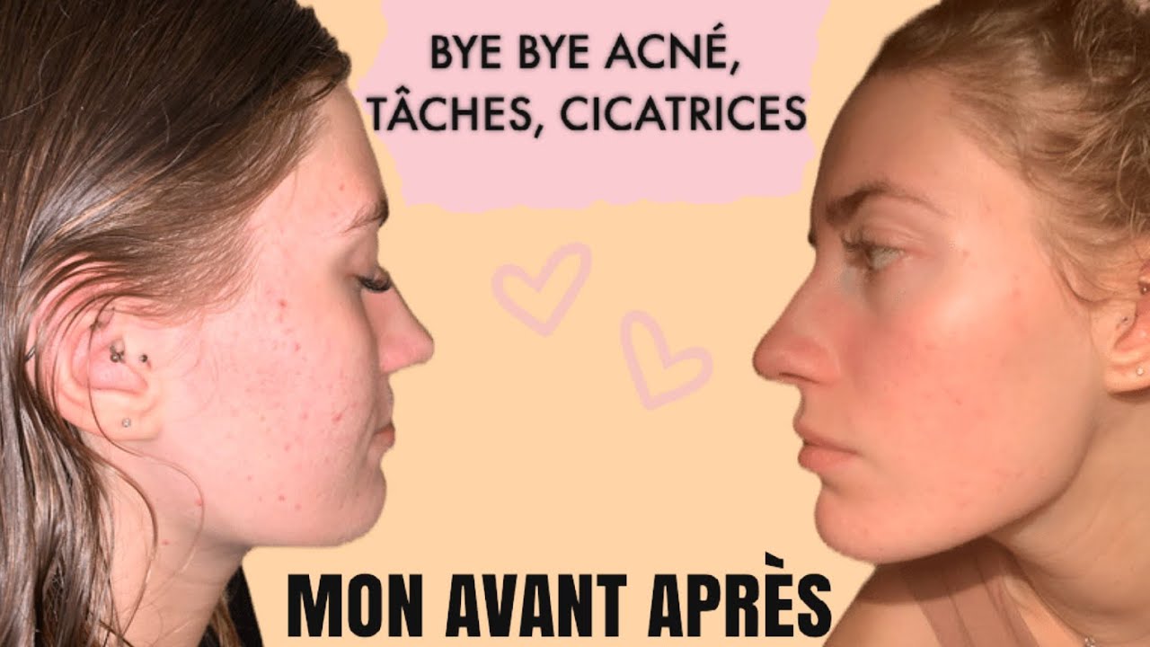 ACNÉ, TÂCHES, CICATRICES... LE PEELING VISAGE : Qu’est ce que c’est ? Pour qui ? Quels résultats ?