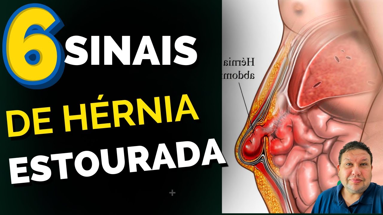 6 SINAIS DE QUE A HÉRNIA PODE ESTAR ESTOURADA