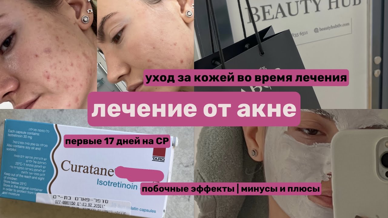 МОЯ ИСТОРИЯ БОРЬБЫ С АКНЕ | Лечение и уход за кожей | Роаккутан и побочки | Выпадение волос