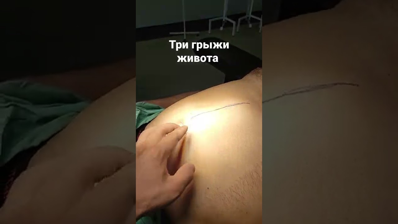 три грыжи живота