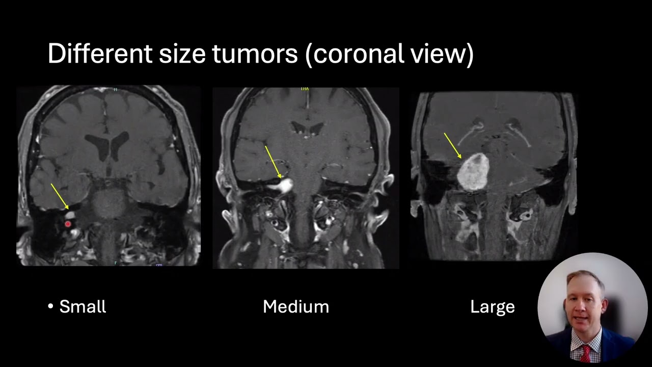 Acoustic Neuroma / Vestibular Schwannoma Tumor: Introduction and Discussion