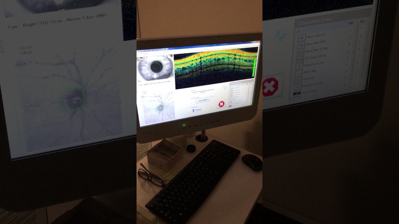 Optovue iVue 100