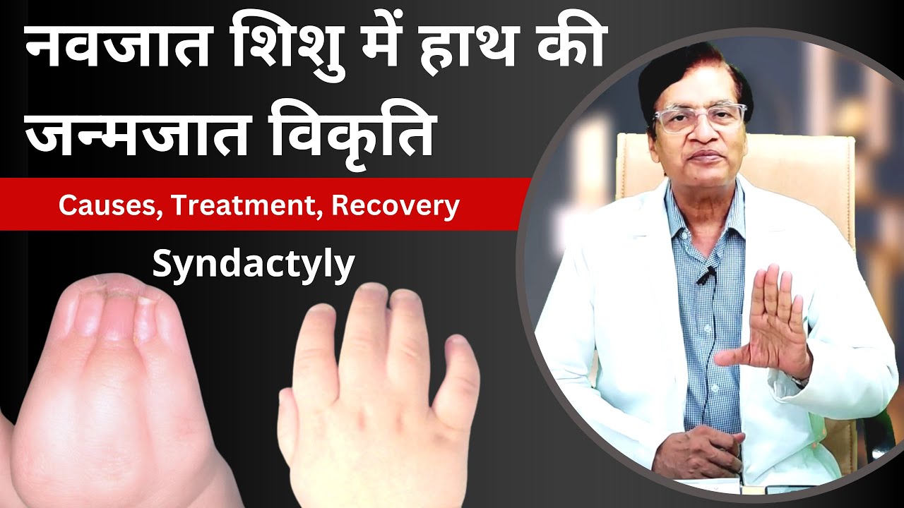 नवजात शिशु में हाथ की जन्मजात विकृति | Syndactyly | Congenital deformities of the Upper Limb